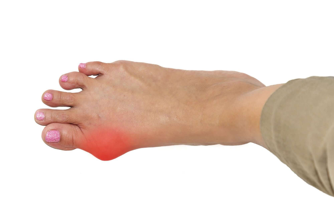 Guide to Bunion Removal Surgery and Recovery